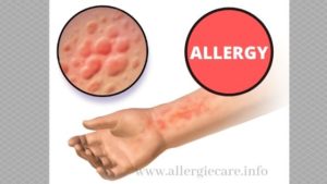 Read more about the article The allergy you should know all about it