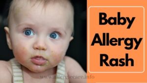 Read more about the article Common Allergy Baby Rash & Best way to Cure