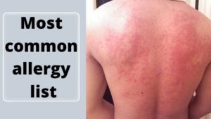Read more about the article Top 10 main best type allergy list as said by a doctor