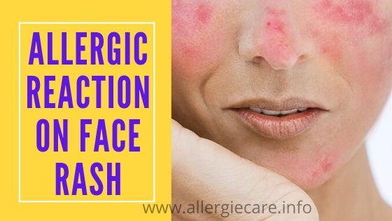 You are currently viewing Allergic reaction on face rash why, and cure