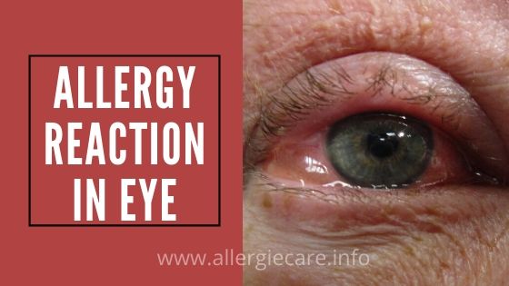 You are currently viewing Common allergy reaction in eye | best care tips