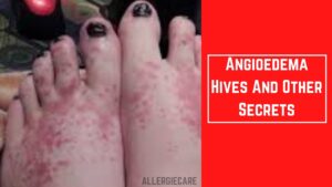 Read more about the article Angioedema Hives And Other Secrets your Family Doesn’t Tell You
